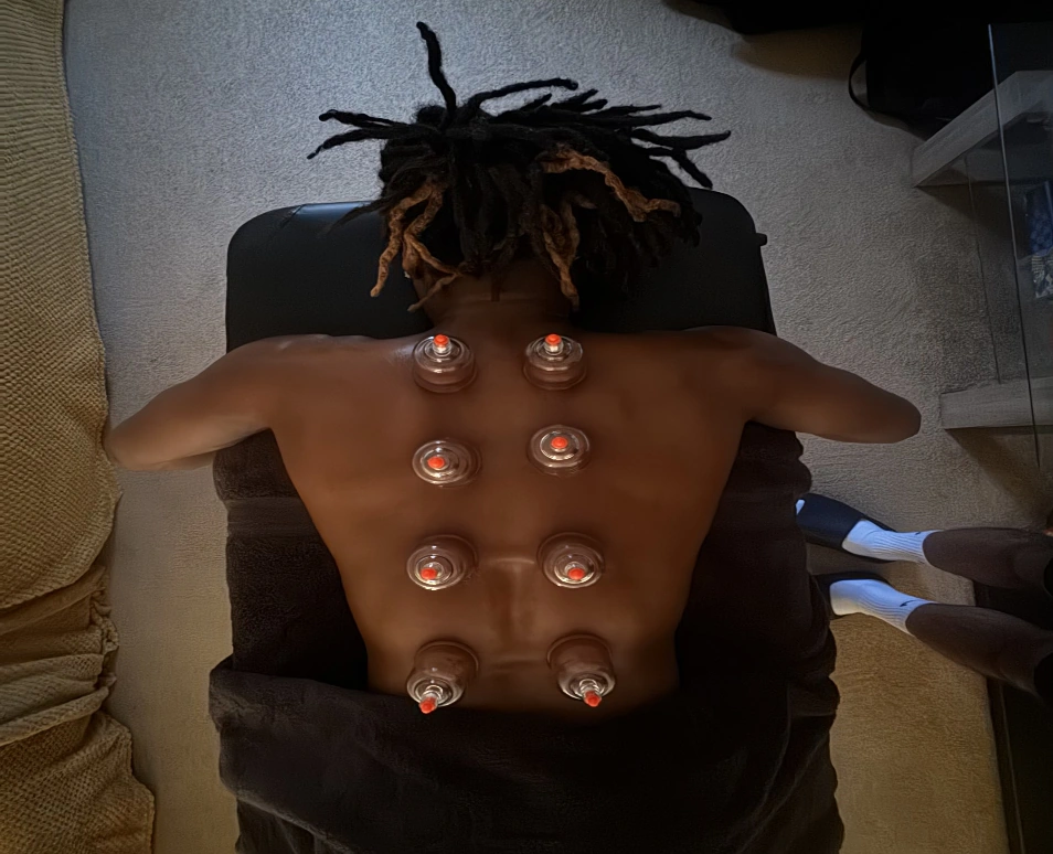 Cupping treatment on a client's back